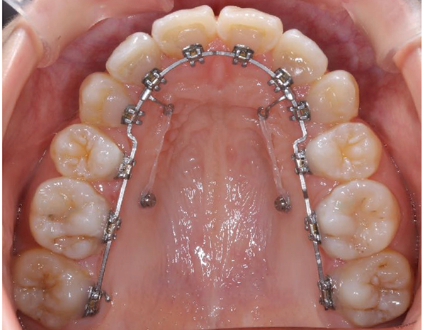 見えない矯正 舌側矯正