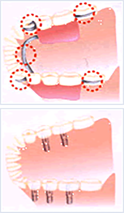 部分入れ歯からインプラントへ