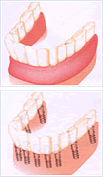 総入れ歯からインプラントへ