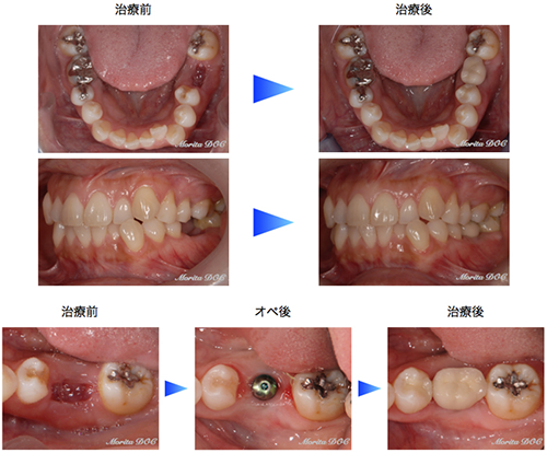 下顎左側第一大臼歯欠損部インプラント症例