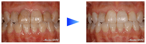 ホームホワイトニング法